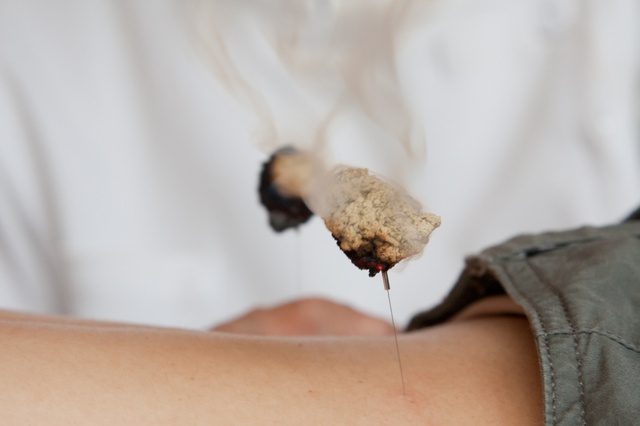 鍼と灸、灸頭鍼