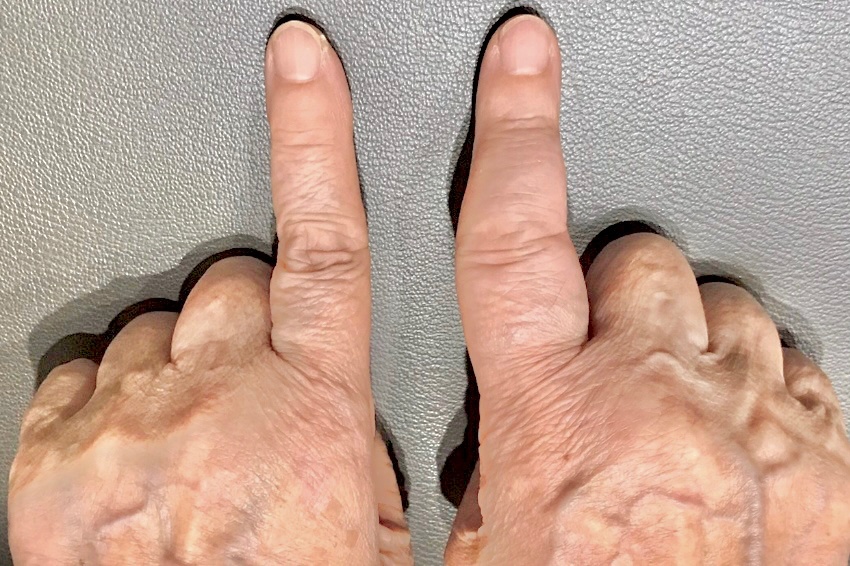 関節リウマチ患者の手指