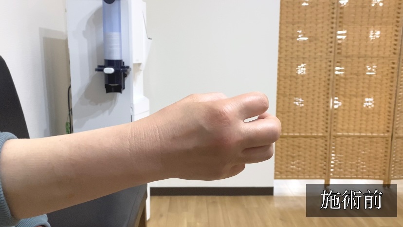 関節リウマチ患者の手指