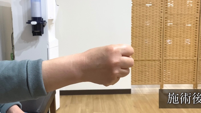 関節リウマチ患者の手指