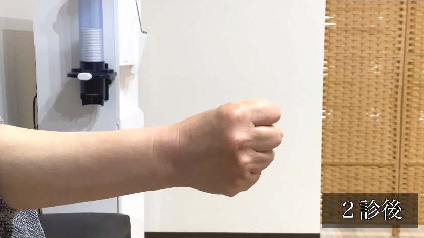 関節リウマチ患者の手指