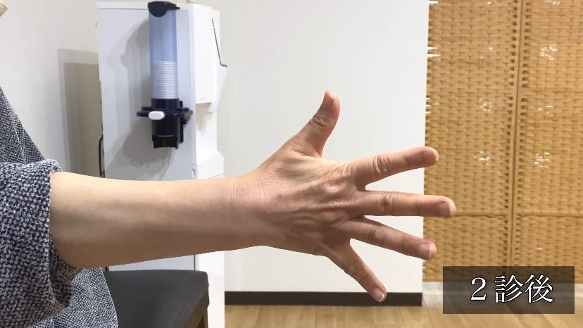 関節リウマチ患者の手指