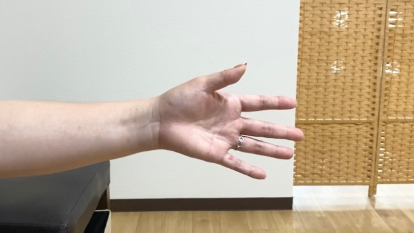 関節リウマチ患者の手指