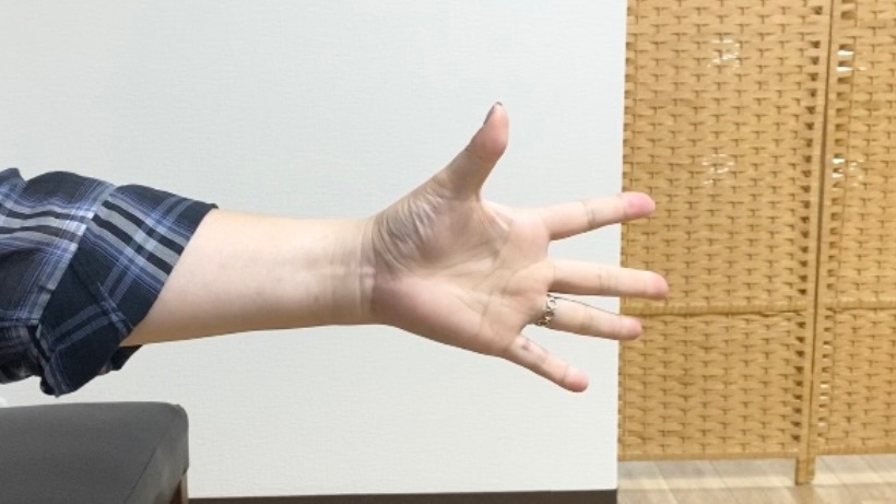 関節リウマチ患者の手指