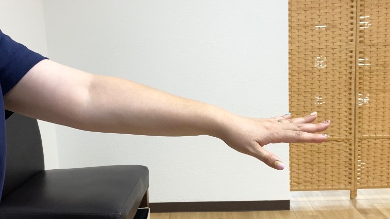 関節リウマチ患者の手指