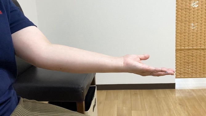 関節リウマチ患者の手指