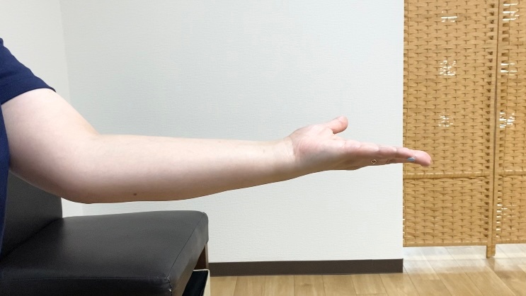 関節リウマチ患者の手指