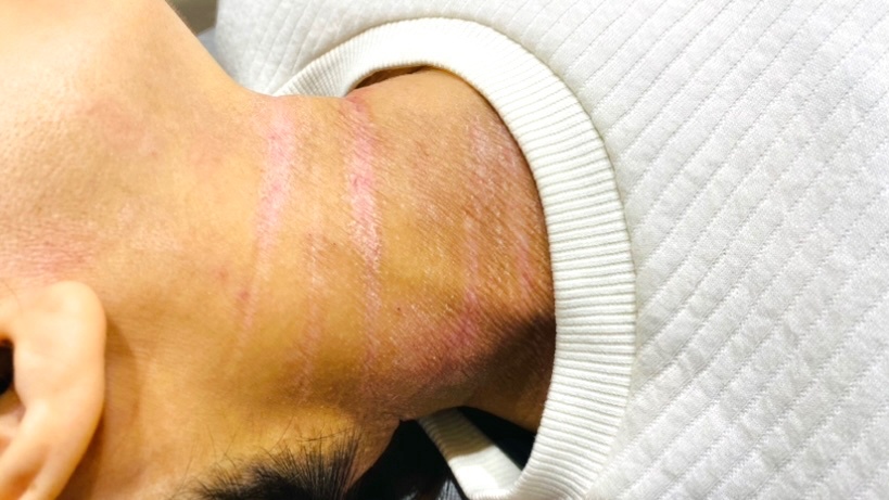 アトピー性皮膚炎