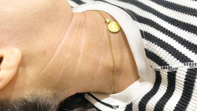 アトピー性皮膚炎