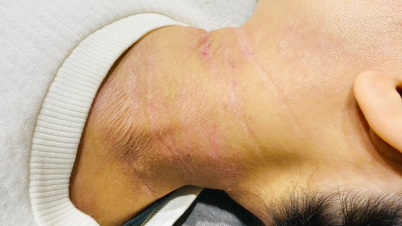 アトピー性皮膚炎