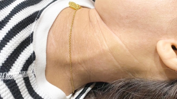 アトピー性皮膚炎