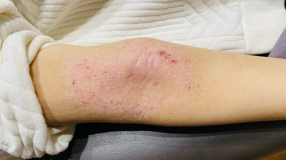 アトピー性皮膚炎