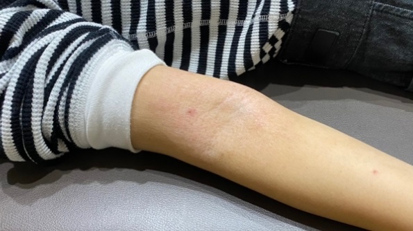 アトピー性皮膚炎