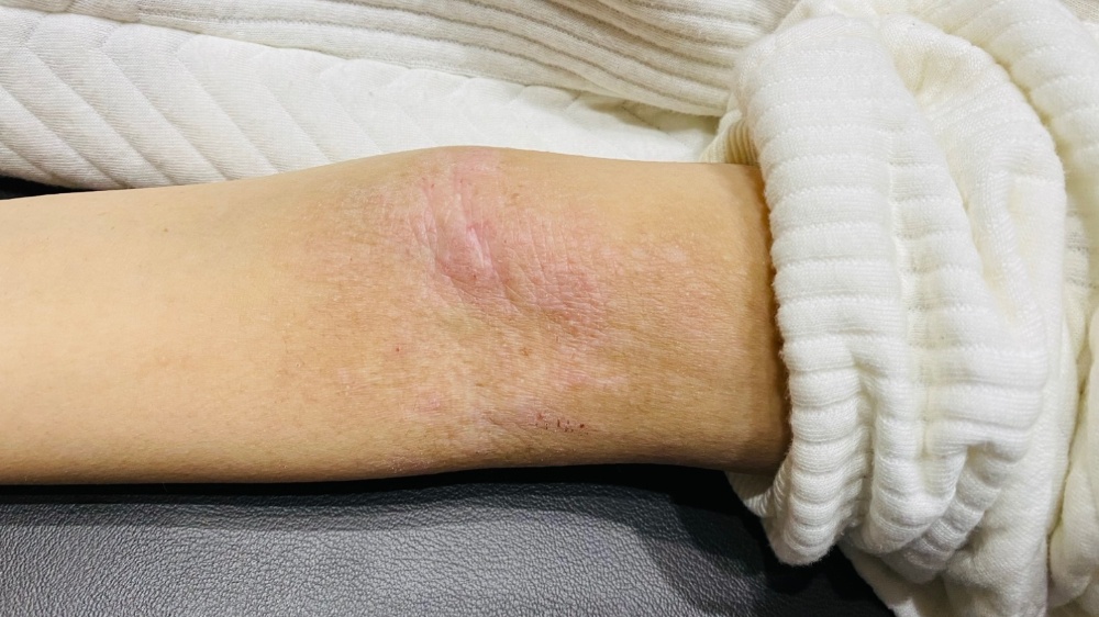 アトピー性皮膚炎