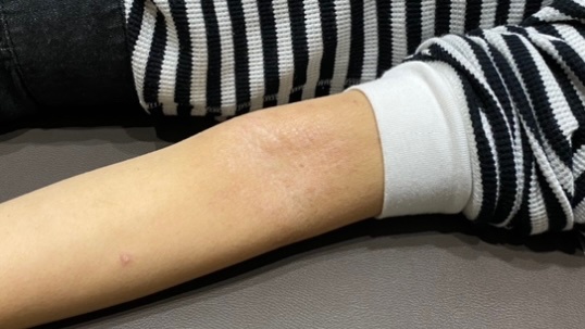 アトピー性皮膚炎