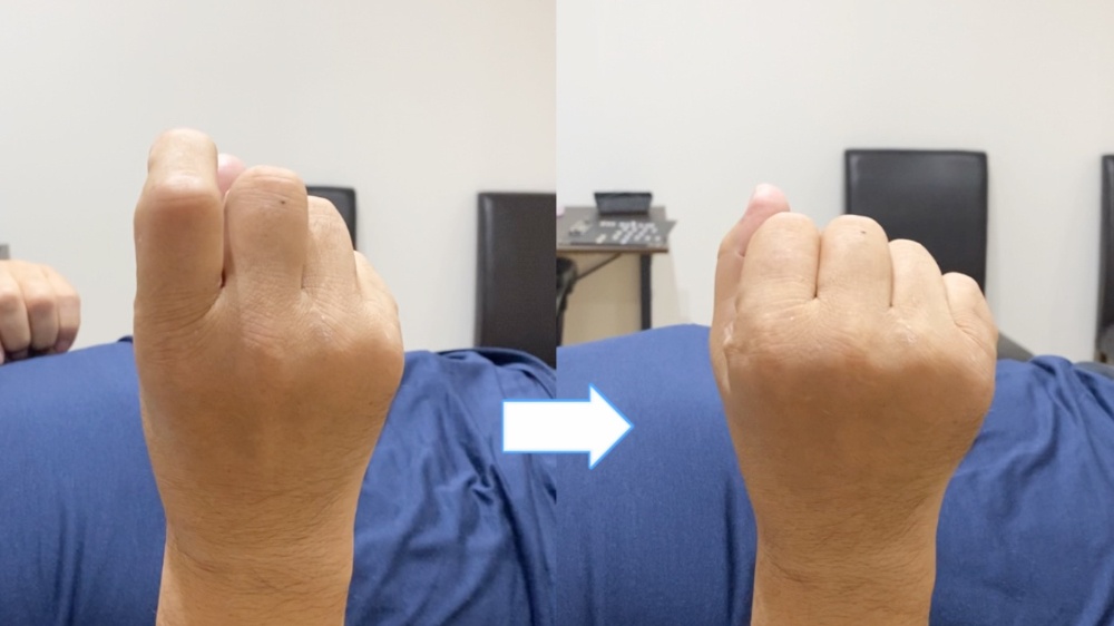 関節リウマチ患者の手指