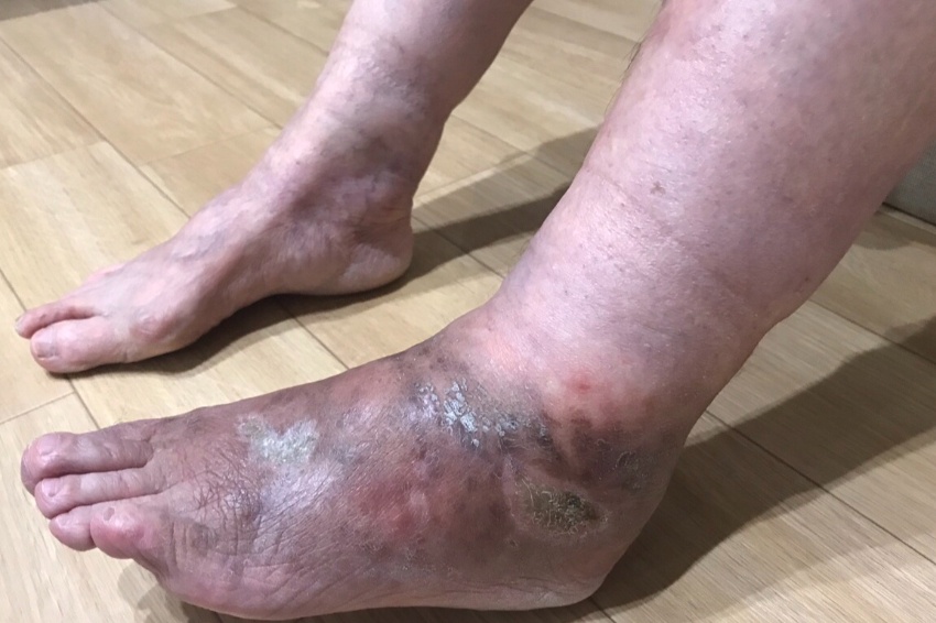 悪性関節リウマチ患者の足