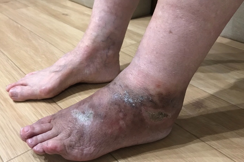 悪性関節リウマチ患者の足