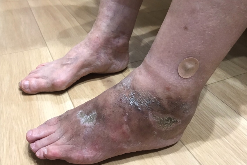 悪性関節リウマチ患者の足