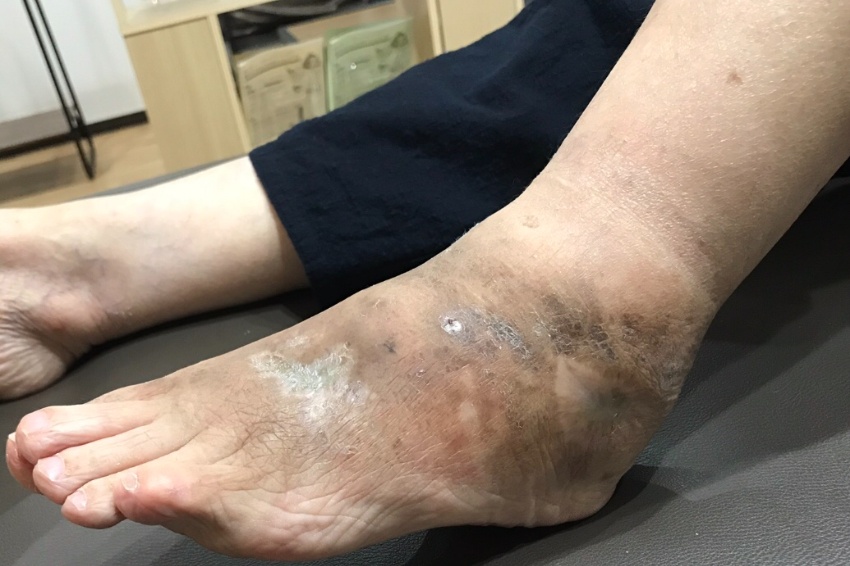 悪性関節リウマチ患者の足