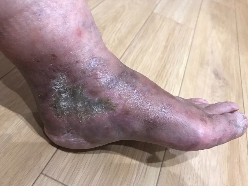 悪性関節リウマチ患者の足
