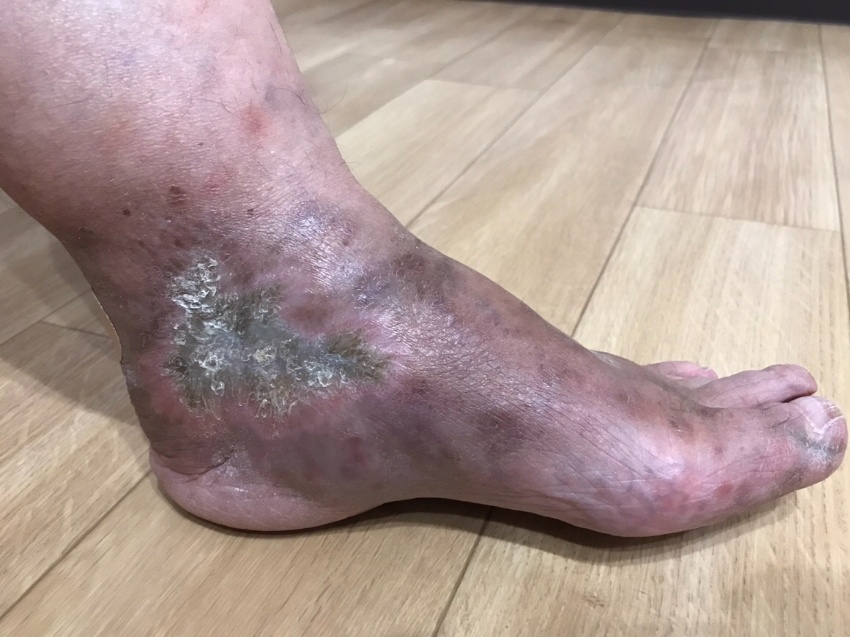 悪性関節リウマチ患者の足