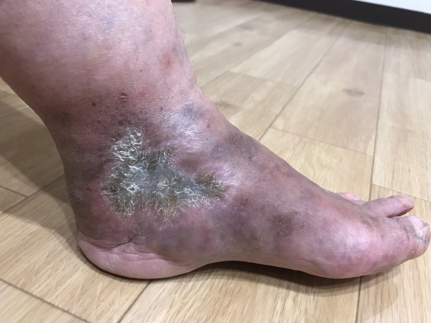 悪性関節リウマチ患者の足