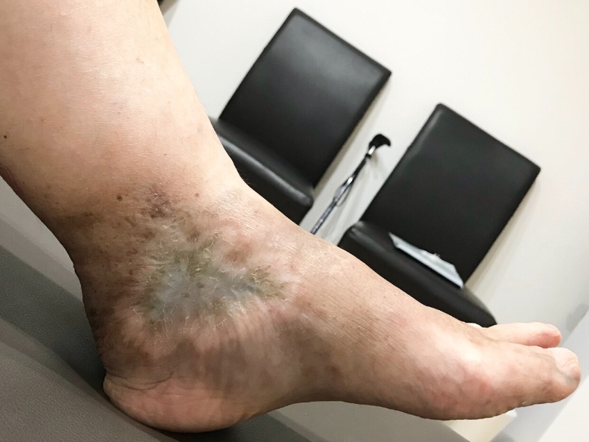 悪性関節リウマチ患者の足