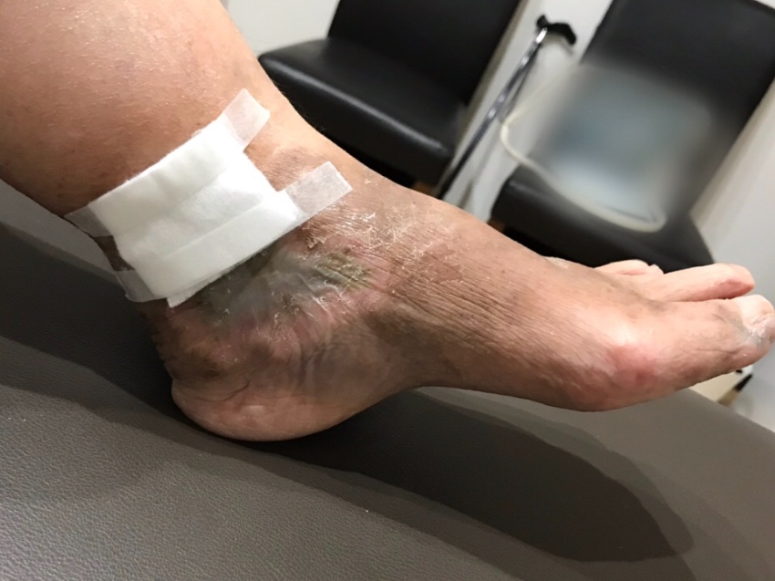 悪性関節リウマチ患者の足