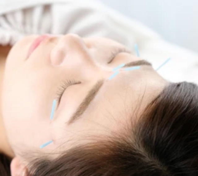 美容鍼をうける女性