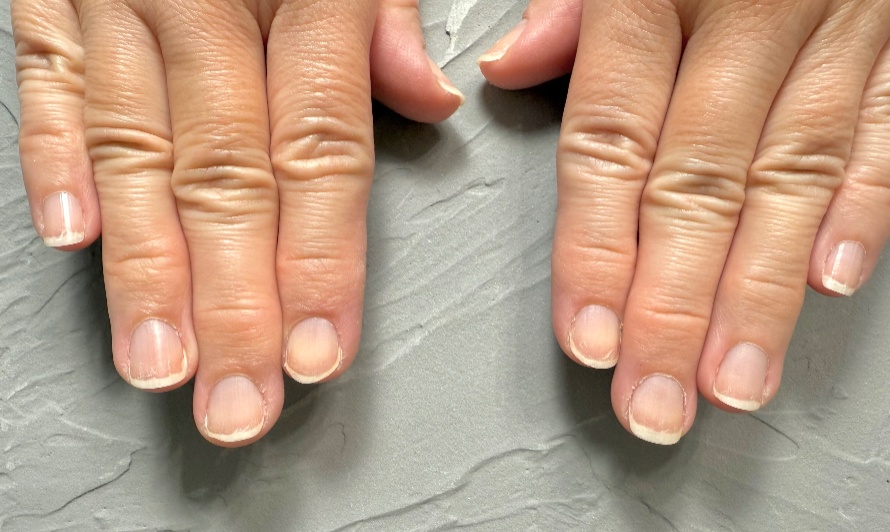 自爪育成のビフォーの手の写真