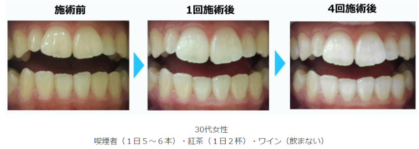 セルフホワイトニング - その他