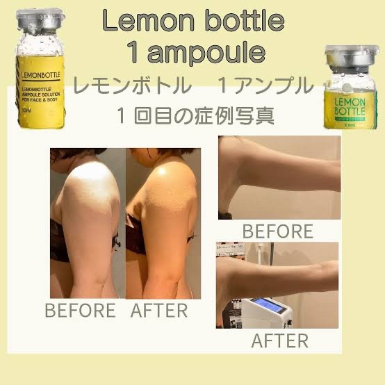 韓国式レモンボトル脂肪溶解コース