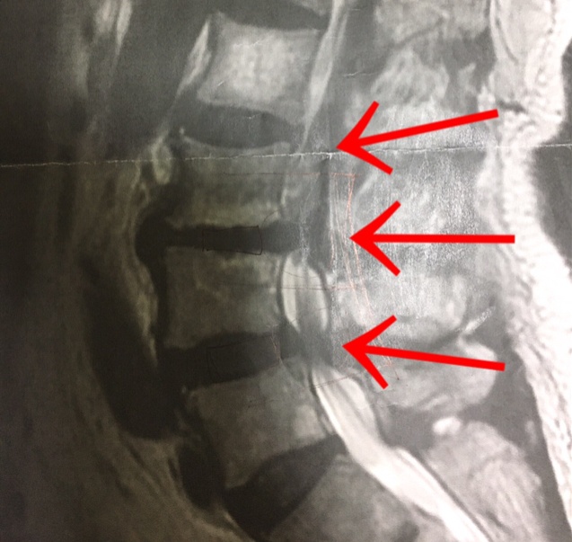浜松市の歓喜整骨院に訪れた脊柱管狭窄症患者のMRI画像