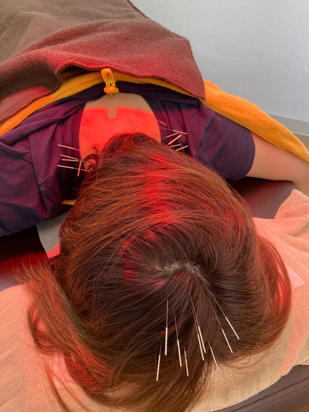 浜松市の安眠専門歓喜はりきゅう院での頭に針治療
