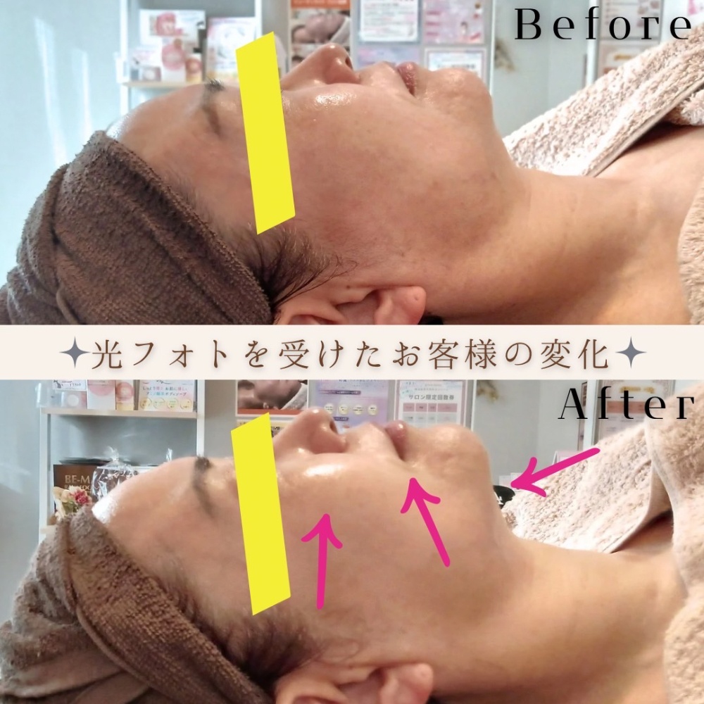 当店に初めてご来店頂いたお客様限定！！全顔＆首照射【光フォトスペシャルトリートメン ト】光フ ォト＆マッサージコース　6 0分　￥  11,000→¥8,800