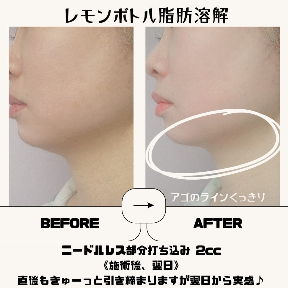 韓国発の脂肪溶解注射剤新メニュー「レモンボトル」｜上野由理